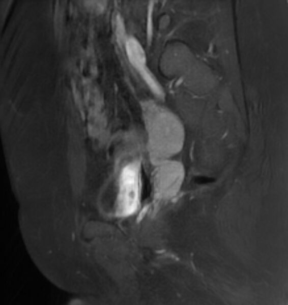 File:Broad ligament leiomyoma (Radiopaedia 81634-95516 G 20).jpg