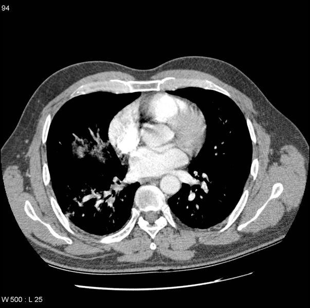File:Bronchial arterial aneurysm (Radiopaedia 22293-22330 A 2).jpg
