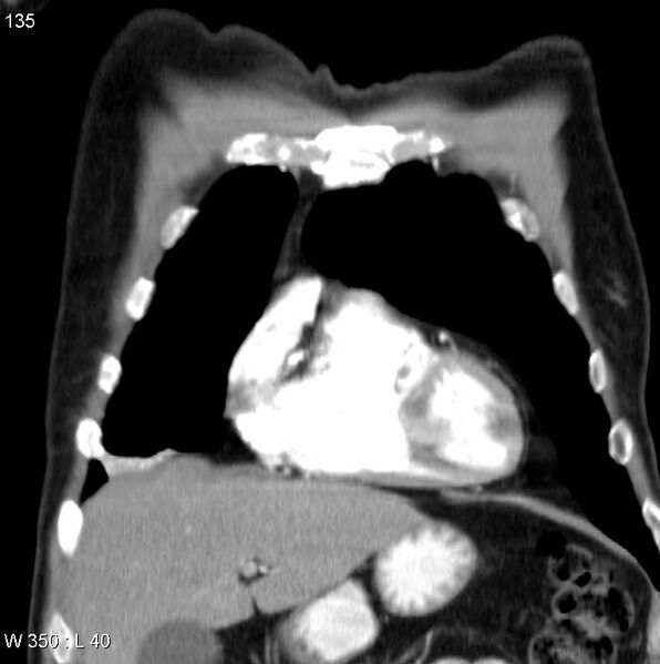 File:Bronchial carcinoid tumor with right lower lobe collapse (Radiopaedia 29060-29422 C 4).jpg