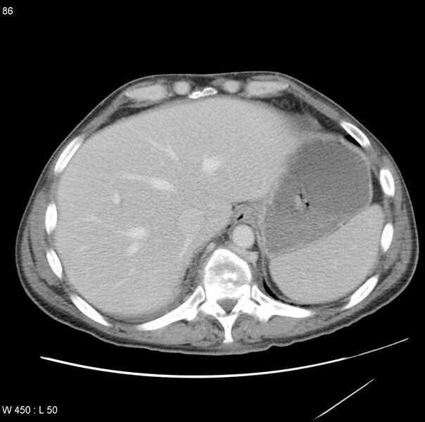 File:Bronchogenic carcinoma (Radiopaedia 8857-9645 A 15).jpg