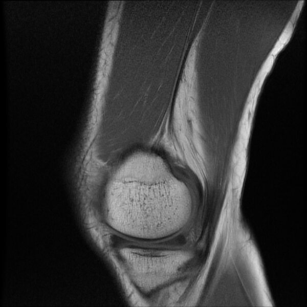 File:Bucket-handle meniscus tear (Radiopaedia 65700-74809 Sagittal T1 6).jpg