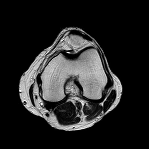 File:Bucket handle tear - medial meniscus (Radiopaedia 29250-29664 Axial T2 10).jpg