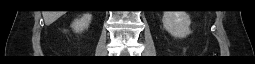 Buried bumper syndrome - gastrostomy tube (Radiopaedia 63843-72575 Coronal Inject 72).jpg