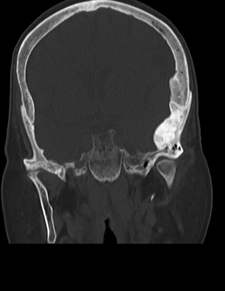 File:Burnt-out meningioma (Radiopaedia 51557-57337 Coronal bone window 24).jpg