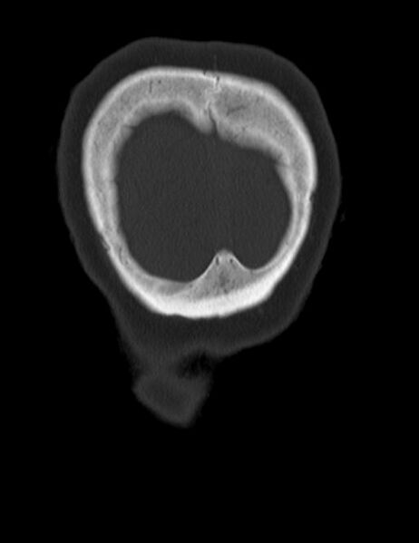 File:Burnt-out meningioma (Radiopaedia 51557-57337 Coronal bone window 53).jpg