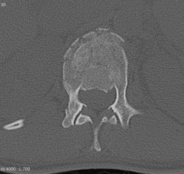 File:Burst fracture (Radiopaedia 5274-7018 Axial bone window 5).jpg