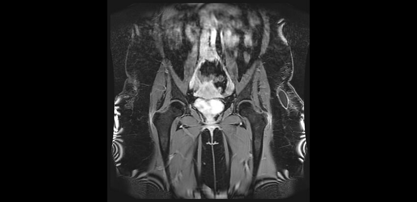 Buttock filler complications (Radiopaedia 63497-72115 Coronal T1 C+ 14).jpg