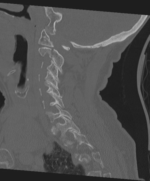File:C2 fracture with vertebral artery dissection (Radiopaedia 37378-39199 Sagittal bone window 50).png