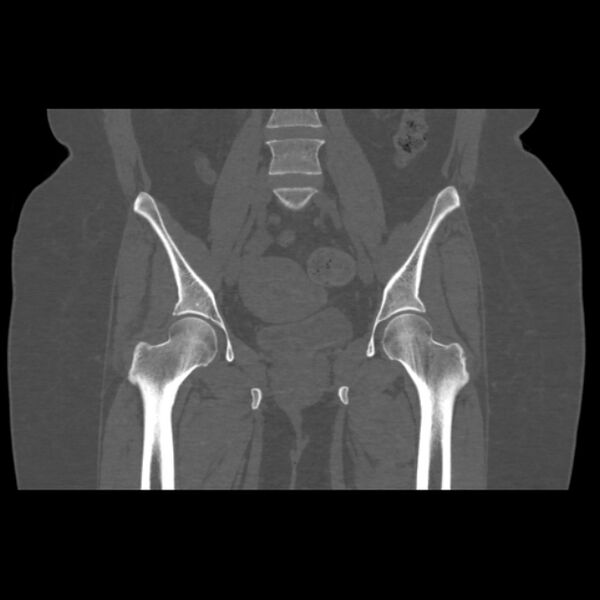 File:Calcific tendinitis of the gluteus medius muscle (Radiopaedia 66998-76318 Coronal bone window 28).jpg