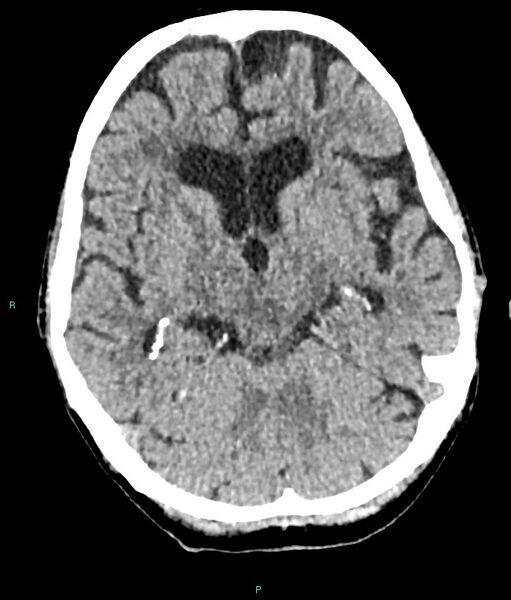 File:Calcified cerebral emboli from left ventricular thrombus (Radiopaedia 84420-99758 Axial non-contrast 58).jpg