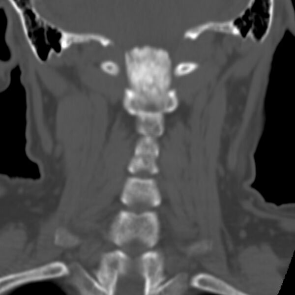 File:Calcified meningioma - cervical canal (Radiopaedia 70136-80171 Coronal bone window 23).jpg