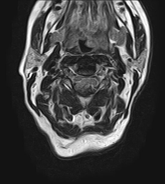 File:Calcified meningioma - cervical canal (Radiopaedia 70136-82468 Axial T2 10).jpg
