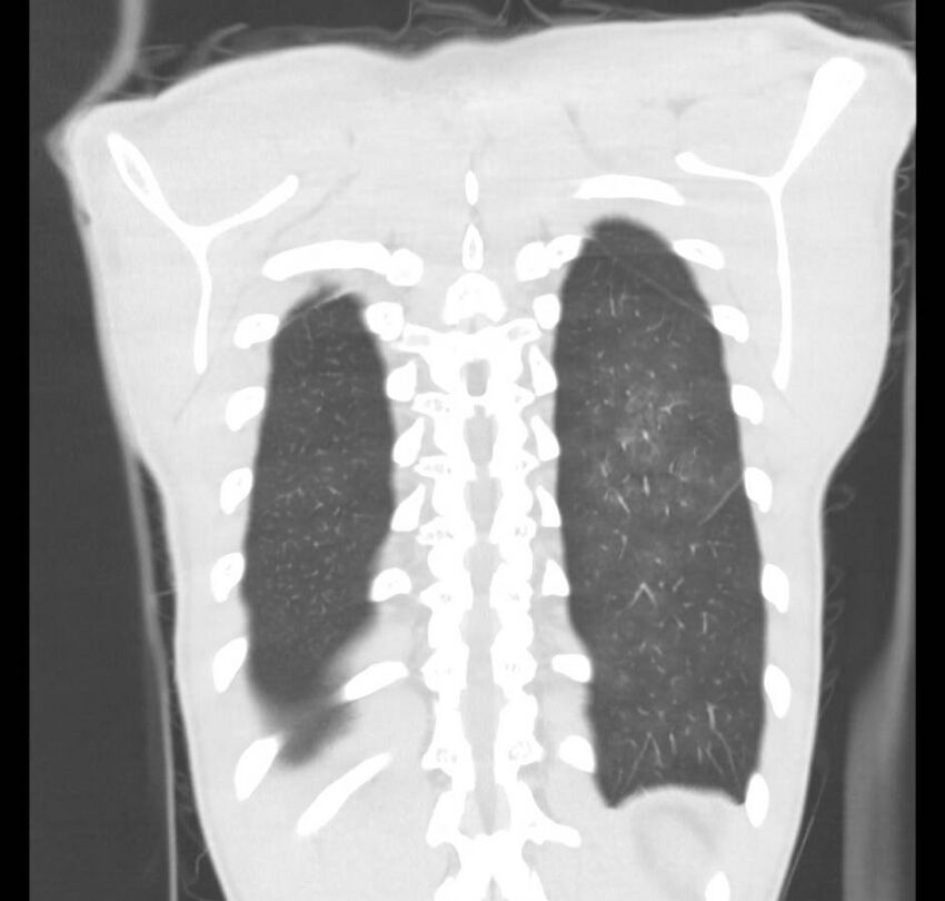 Cannabis-induced diffuse alveolar hemorrhage (Radiopaedia 89834-106946 Coronal lung window 11).jpg