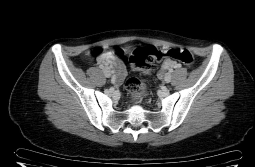 Cannonball metastases - uterine choriocarcinoma (Radiopaedia 70137-80174 A 8).jpg