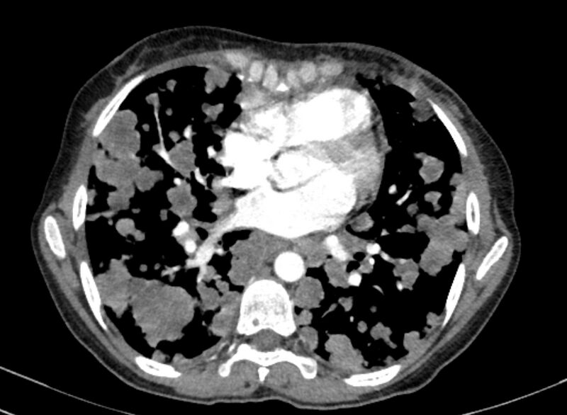 File:Cannonball metastases from breast cancer (Radiopaedia 91024-108569 A 72).jpg