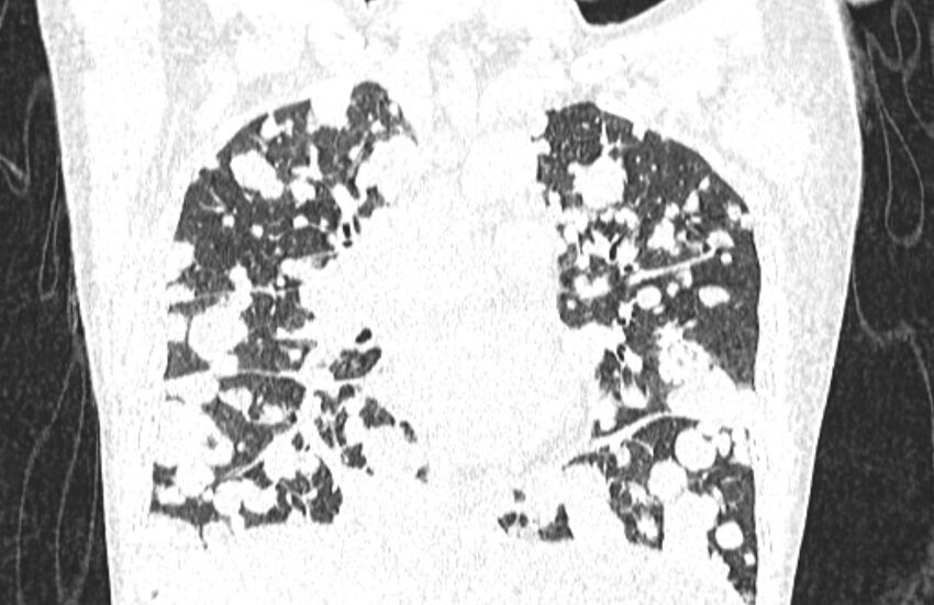 Cannonball metastases from breast cancer (Radiopaedia 91024-108569 Coronal lung window 70).jpg