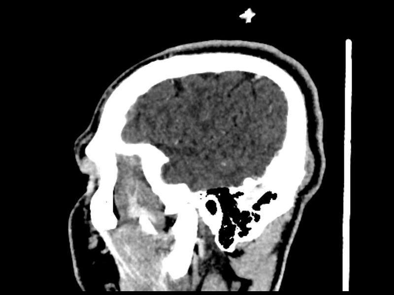 File:Capillary hemangioma of the orbit (Radiopaedia 44610-48358 C 8).jpg
