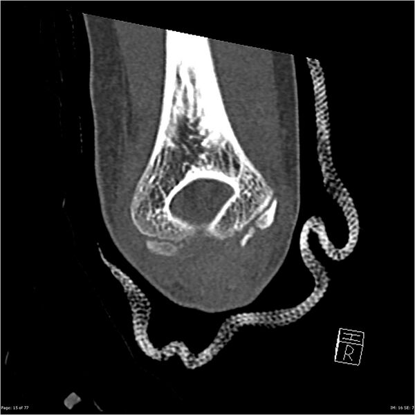 File:Capitellum fracture (Radiopaedia 23352-23426 Coronal bone window 15).jpg