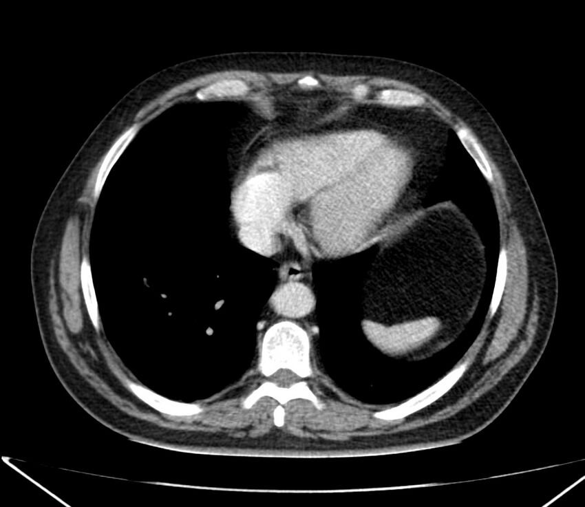 Carcinoid tumor with hepatic metastases (Radiopaedia 22651-22670 C 26).jpg