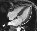 Cardiac amyloidosis (Radiopaedia 39736-42124 D 27).jpg