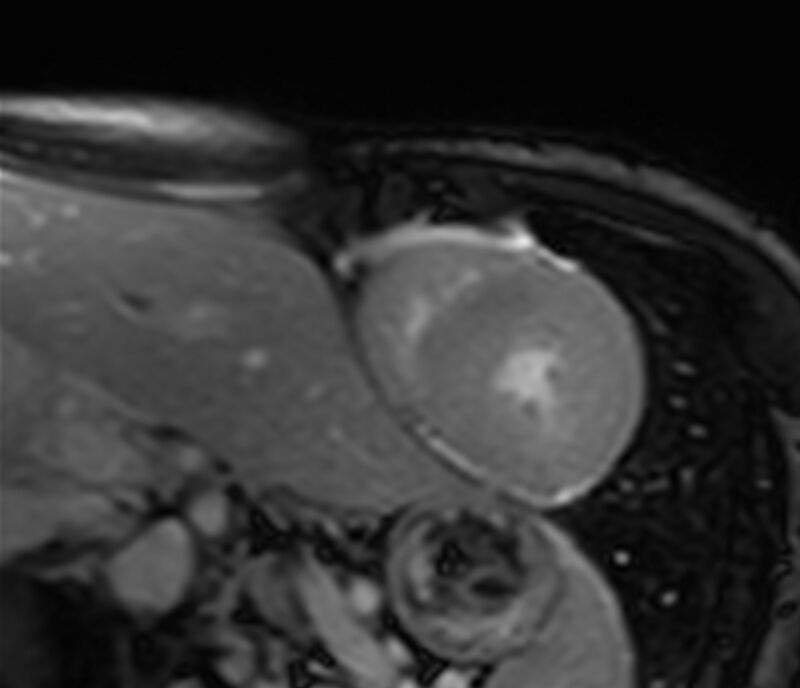 Cardiac amyloidosis (Radiopaedia 39736-42124 F 131).jpg