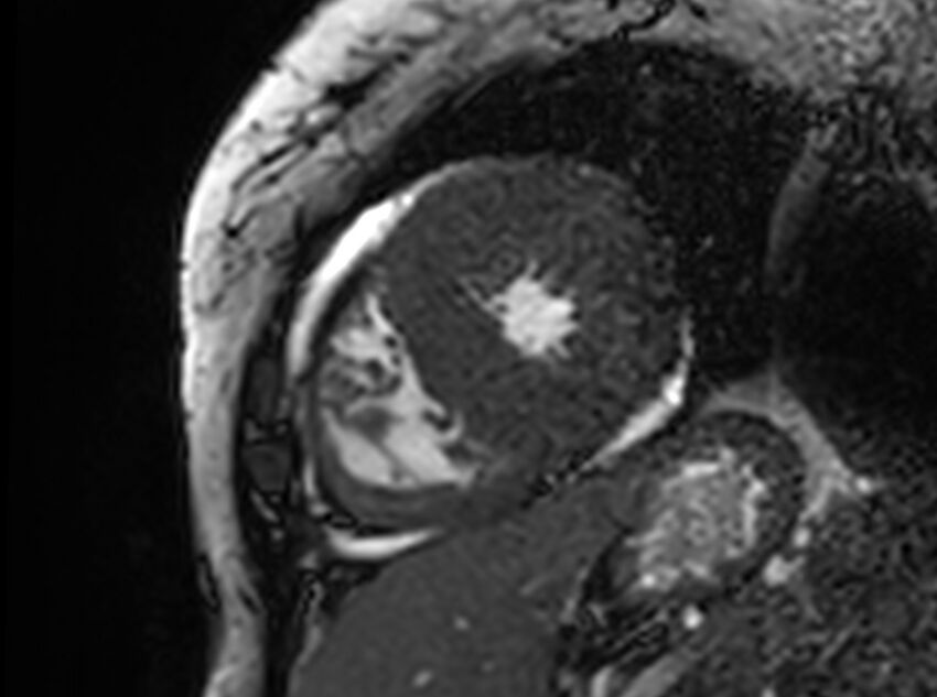 Cardiac amyloidosis (Radiopaedia 61600-69579 Short axis bSSFP 106).jpg