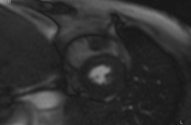 File:Cardiac hemangioma (Radiopaedia 31709-32631 Short axis 94).jpg