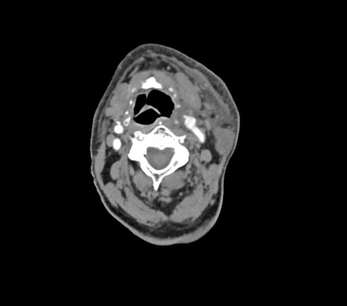 File:Carotid artery pseudoaneurysm (Radiopaedia 84030-99259 C 35).jpg
