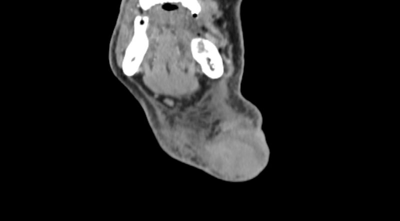 File:Carotid artery pseudoaneurysm (Radiopaedia 84030-99259 D 3).jpg