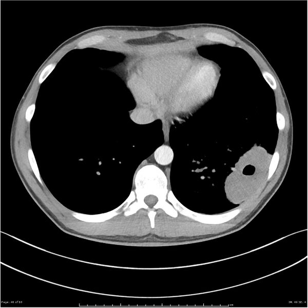 File:Cavitating lung cancer (Radiopaedia 25796-25945 C+ arterial phase 46).jpg