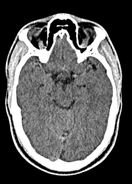 File:Cavum septum pellucidum and cavum vergae (Radiopaedia 77797-90060 Axial Brain Window 41).jpg
