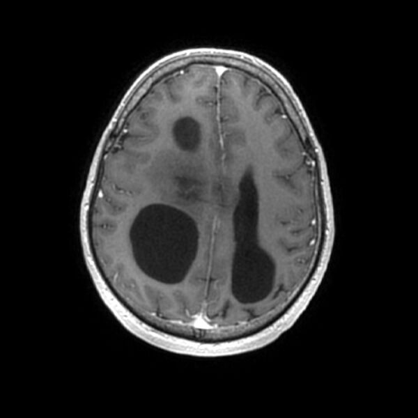 File:Central neurocytoma (Radiopaedia 67618-77021 Axial T1 C+ 21).jpg
