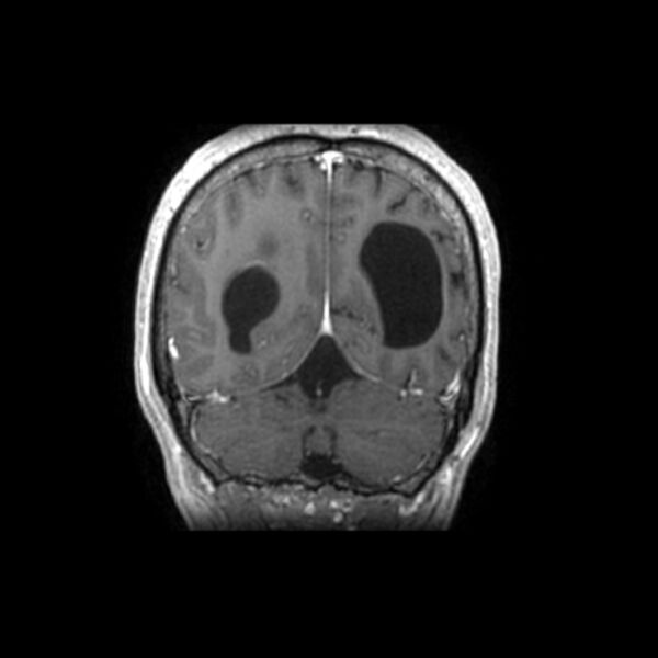File:Central neurocytoma (Radiopaedia 67618-77021 Coronal T1 C+ 5).jpg