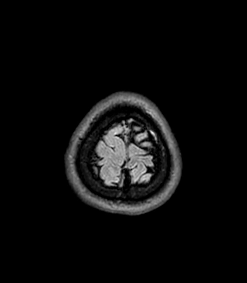 Central neurocytoma (Radiopaedia 79320-92380 Axial FLAIR 41).jpg