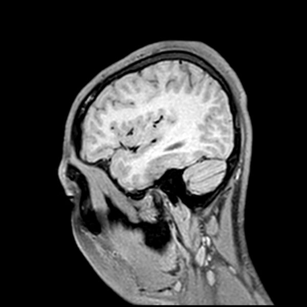 File:Central neurocytoma (Radiopaedia 79320-92380 Sagittal T1 205).jpg