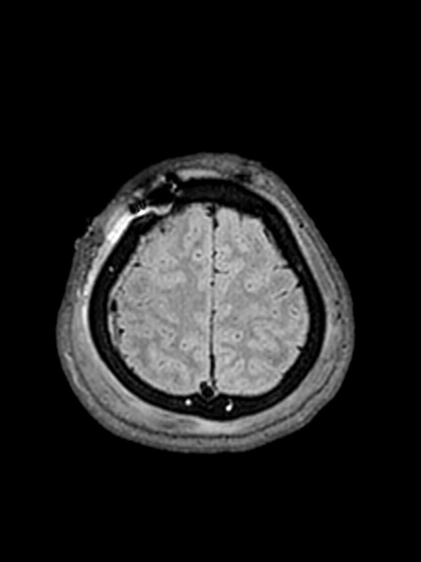 Central neurocytoma (Radiopaedia 79320-92381 Axial FLAIR 38).jpg