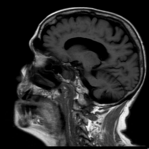 File:Cerebellar ataxia with neuropathy and vestibular areflexia syndrome (CANVAS) (Radiopaedia 74283-85159 Sagittal FLAIR 13).jpg