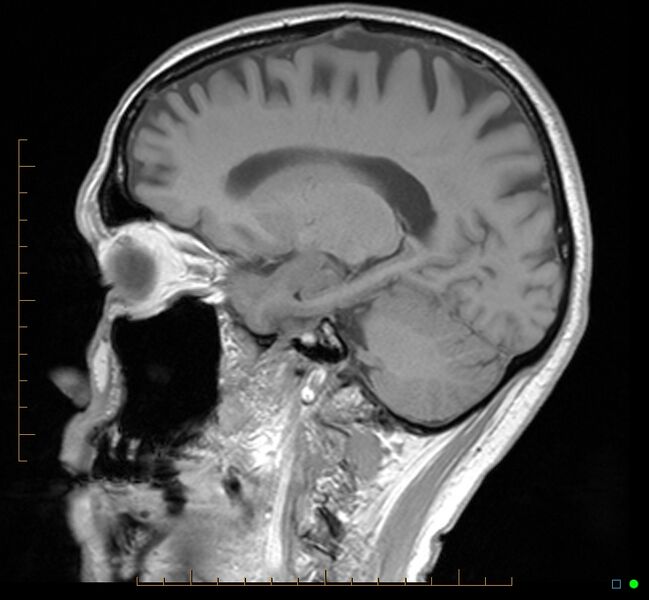 File:Cerebellar gangliocytoma (Radiopaedia 65377-74422 Sagittal T1 28).jpg