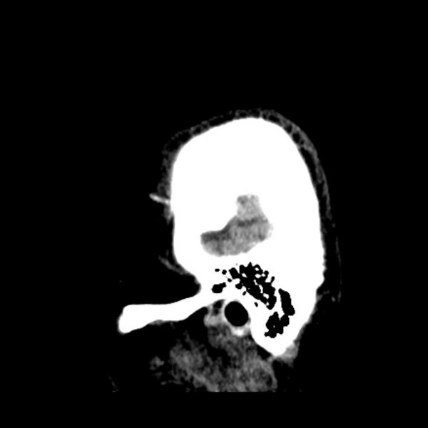 File:Cerebellar hemorrhage (Radiopaedia 27193-27359 C 4).jpg