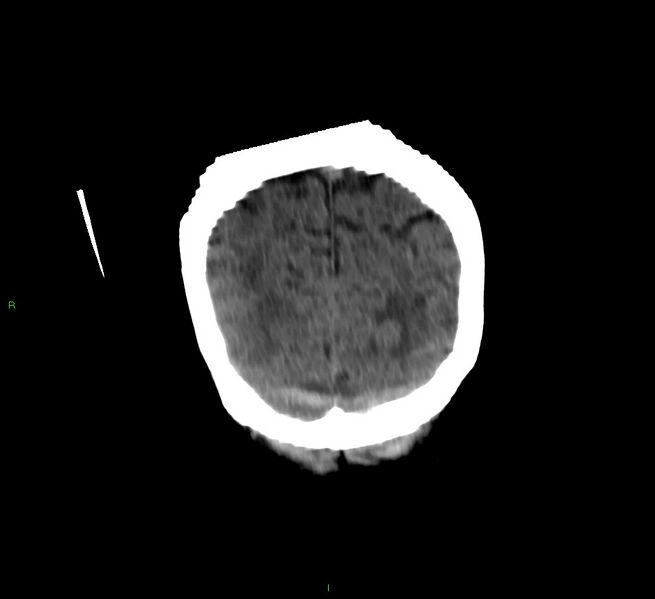 File:Cerebellar hemorrhage (Radiopaedia 58792-66026 Coronal non-contrast 13).jpg