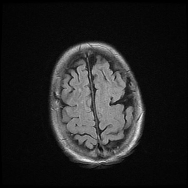 File:Cerebellar metastasis - lung tumor (Radiopaedia 69317-79147 Axial FLAIR 3).jpg