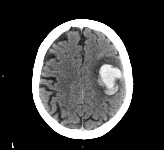 File:Cerebral amyloid angiopathy-associated lobar intracerebral hemorrhage (Radiopaedia 58376-65511 Axial non-contrast 19).jpg