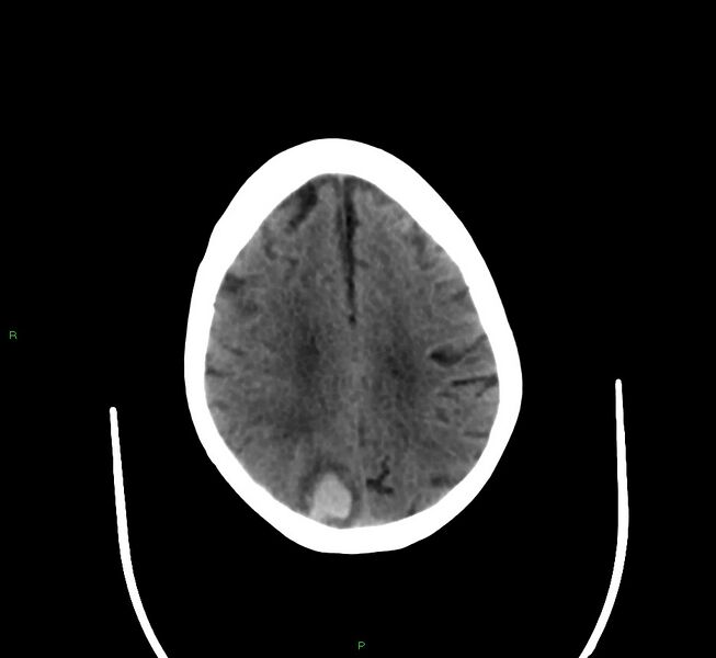 File:Cerebral amyloid angiopathy-associated lobar intracerebral hemorrhage (Radiopaedia 58377-65514 Axial non-contrast 15).jpg