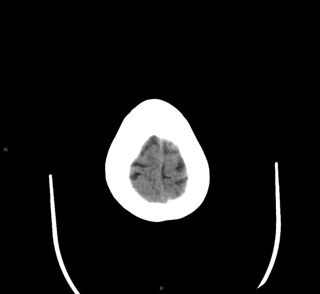 File:Cerebral amyloid angiopathy-associated lobar intracerebral hemorrhage (Radiopaedia 58377-65514 Axial non-contrast 5).jpg
