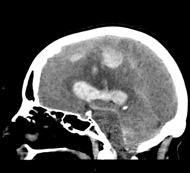 File:Cerebral amyloid angiopathy-associated lobar intracerebral hemorrhage (Radiopaedia 58379-65519 C 29).jpg