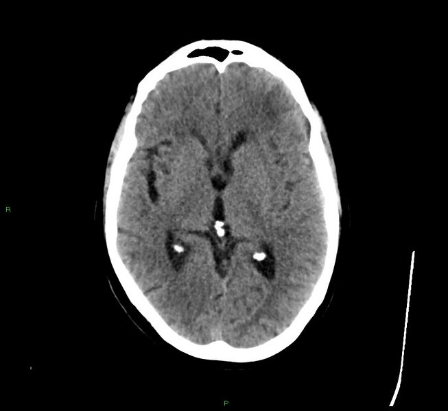 File:Cerebral amyloid angiopathy-associated lobar intracerebral hemorrhage (Radiopaedia 58529-65681 Axial non-contrast 28).jpg