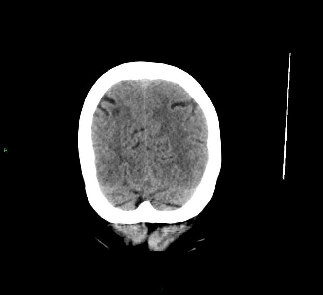 File:Cerebral amyloid angiopathy-associated lobar intracerebral hemorrhage (Radiopaedia 58529-65681 Coronal non-contrast 13).jpg