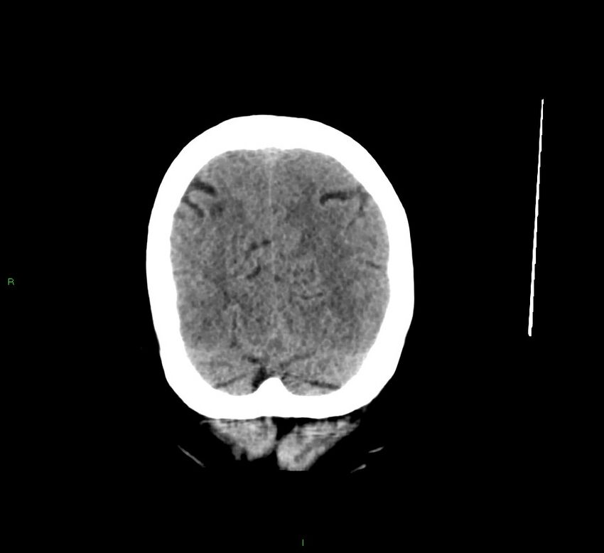 Cerebral amyloid angiopathy-associated lobar intracerebral hemorrhage (Radiopaedia 58529-65681 Coronal non-contrast 13).jpg