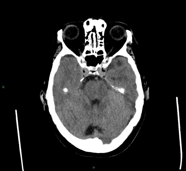 File:Cerebral amyloid angiopathy-associated lobar intracerebral hemorrhage (Radiopaedia 58560-65723 Axial non-contrast 37).jpg