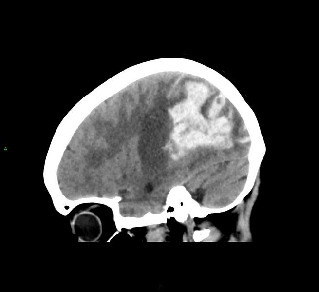 File:Cerebral amyloid angiopathy-associated lobar intracerebral hemorrhage (Radiopaedia 58563-65727 C 18).jpg
